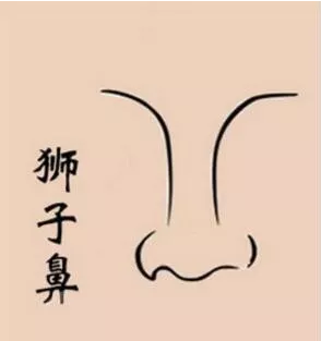 狮子鼻露灶鼻也就是大家常说的露孔鼻,又叫开风鼻.